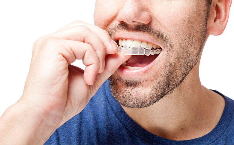 invisalign-sistemi
